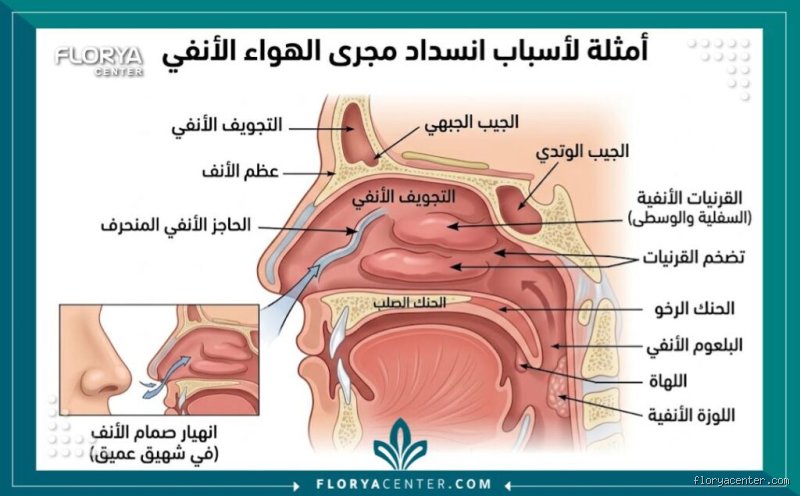 ما هي أسباب انسداد مجرى التنفس؟