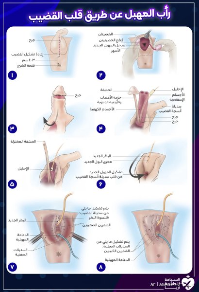 لماذا لا تخضع معظم النساء المتحولات جنسياً لعملية جراحية لتغيير الأعضاء التناسلية؟