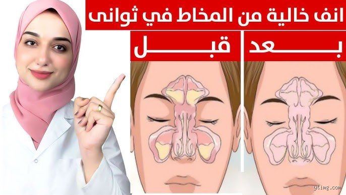 ما هو مذيب مخاط الأنف وكيف ينهي معاناة الانسداد المزمن؟