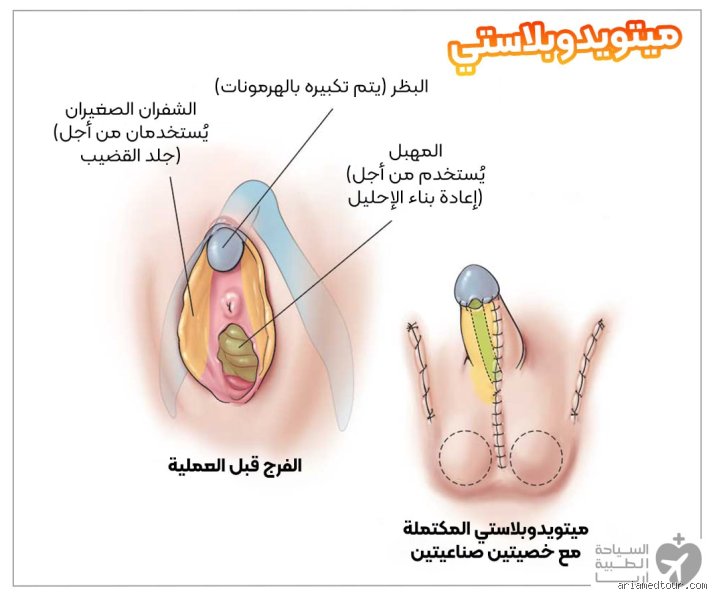 متى يكون التحول الجنسي حلالًا؟ قراءة في ثنائية الطب والشرع