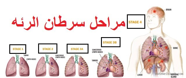 ما هي المرحلة الأولى من أمراض الرئة؟ فخ الصمت الذي يتجاهله الملايين
