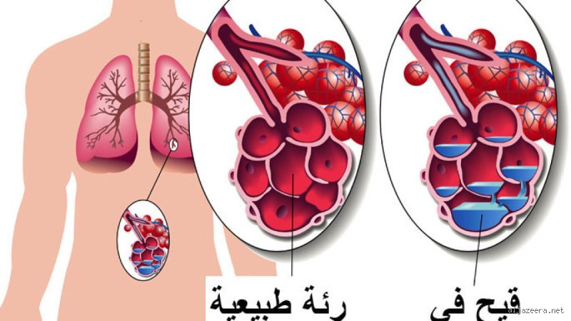 ما الذي يقتل البكتيريا في الرئتين بشكل طبيعي؟