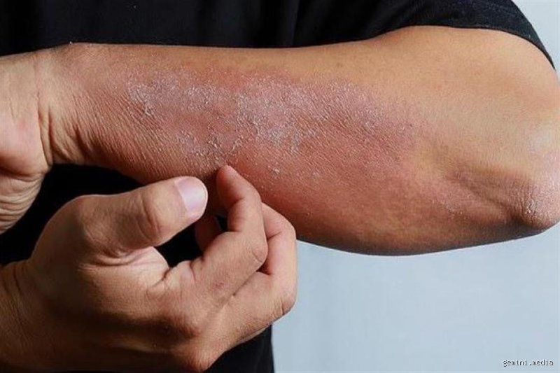 هل الفياجرا تسبب حساسية الجلد؟ الحقيقة الطبية وراء التفاعلات الجلدية