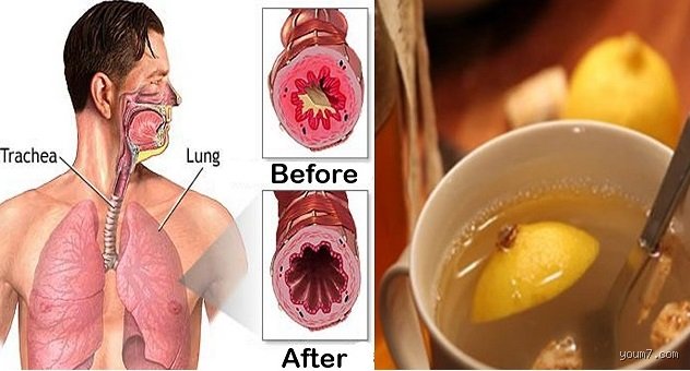ما الذي يزيل البلغم فوراً؟ دليلك العملي للتخلص من احتقان الصدر
