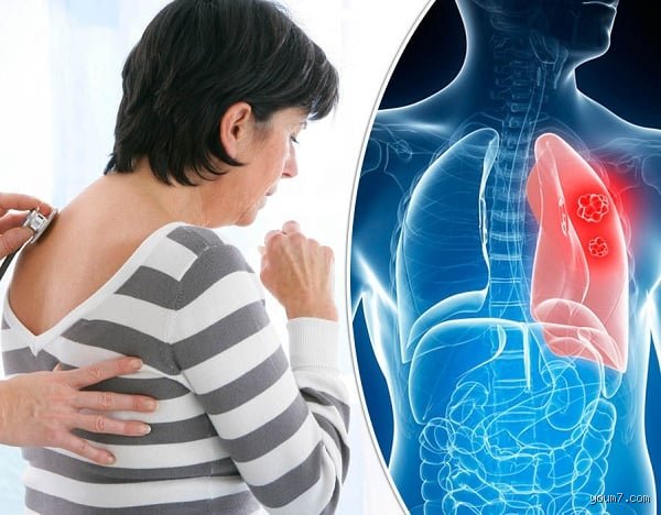 أين يكون ألم الرئتين؟ الموقع لا يكذب لكنه يُضلل