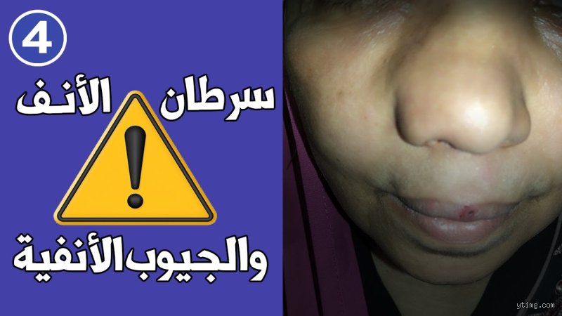 ما هي أعراض وجود ورم في الأنف؟ دليلك الشامل لفك تشفير الإشارات الخفية