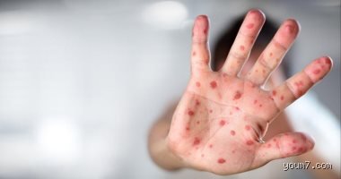 لغز "إمبوكس" المتجدد: ما هو الفيروس المنتشر حاليا في أفريقيا وكيف يهدد أمننا الصحي؟
