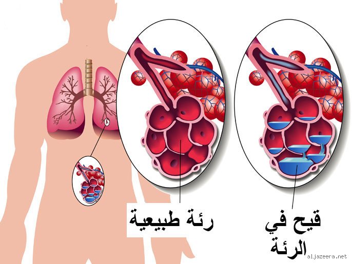 كيف أعرف أن الرئة عندي فيها مشكلة؟ دليلك لفهم لغة جسدك الخفية