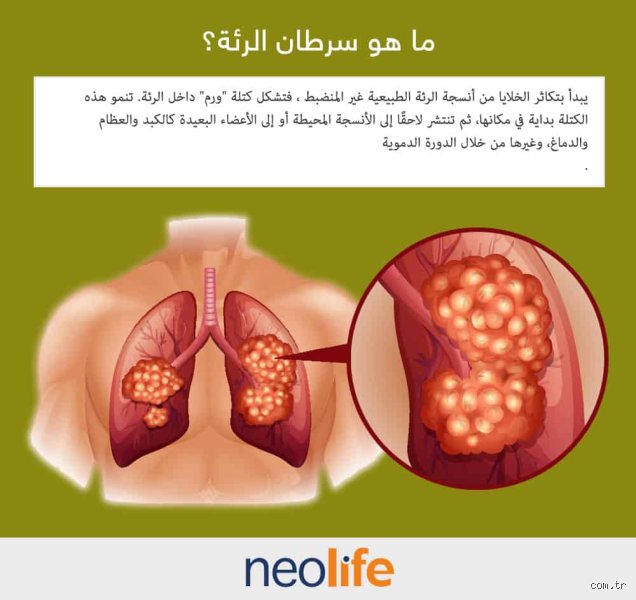 ما هي أعراض سرطان الرئة؟ الدليل الطبي الشامل للعلامات المبكرة
