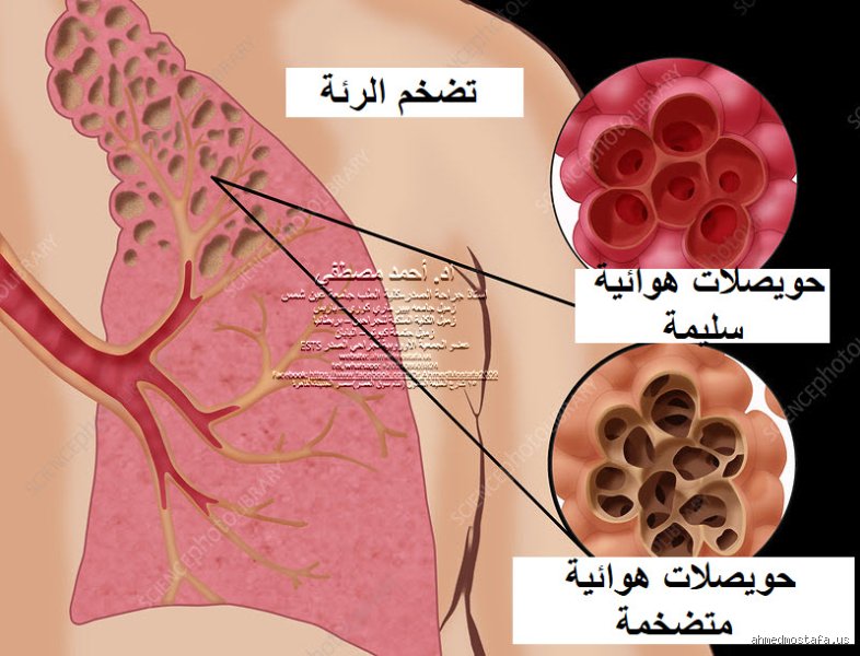 ما هو مرض تضخم الرئة؟ الدليل الطبي الشامل لفهم أنفاسك المخنوقة