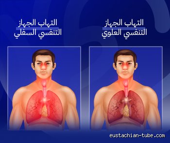 ما هي أسرع طريقة للتخلص من عدوى الجهاز التنفسي؟
